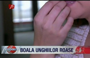 Boala unghiilor roase