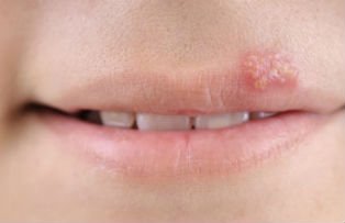 Cum scapi de herpes. 3 metode rapide