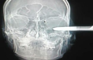 Intamplare neobisnuita intr-un spital. Ce le-a spus medicilor un barbat care a intrat la Urgente cu o foarfeca in cap