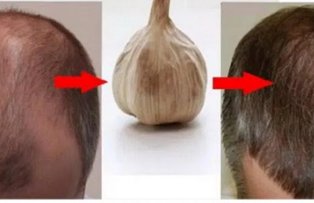 Afla de ce usturoiul este cel mai bun remediu natural impotriva caderii parului cauzate de micoze