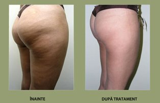 Cum sa invingi celulita „veche“.  Iata cele mai eficiente metode