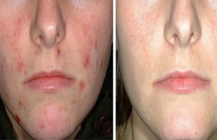 Ceaiuri care vindeca problemele pielii si-ti întineresc tenul