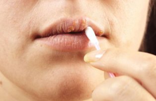 3 lucruri mai putin cunoscute despre herpes