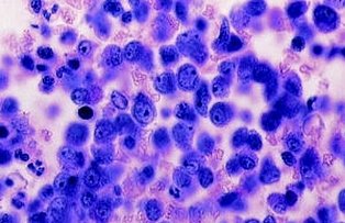 Semintele unui fruct cunoscut distrug celulele canceroase mai repede decat chimioterapia. Cum este posibil