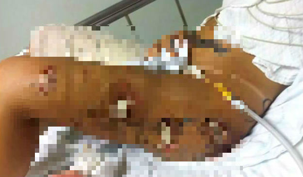 Mutilata dupa ce si-a pus silicon: "Muschii sunt putreziti, am gauri in picioare"