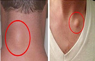 Suferi de noduli subcatanati (lipoame)? Iata cum poti scapa de ei in doar 8 zile, fara operatie