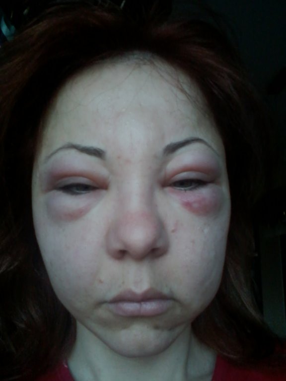 A fost mutilata de estetician! O avocata din Alba a vrut sa se trateze de riduri, insa i-a paralizat fata
