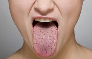 Ai gura uscata? Scapa de problema cu ajutorul unui remediu natural