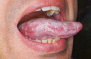 Ai limba incarcata de depozite albicioase sau galbui? Mergi imediat la doctor, nu este de joaca!