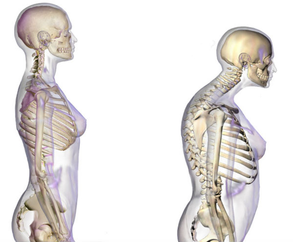 Metode terapeutice de tratare a osteoporozei şi tratament cu remedii populare, simptome şi cauze ale bolii